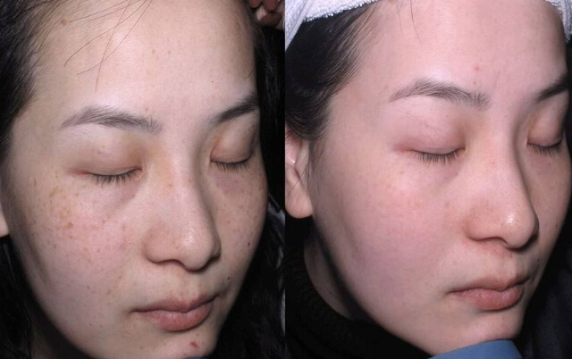 御芙莲祛斑加盟 御芙莲祛斑加盟