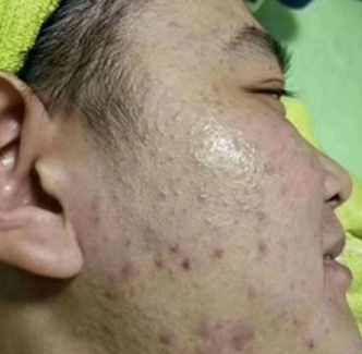 苗方淡斑祛痘加盟案例图片