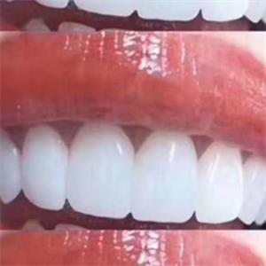  Ice magnetic teeth beauty