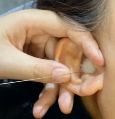  Cephalotherapy ear picking