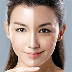 香港面之吻淡斑